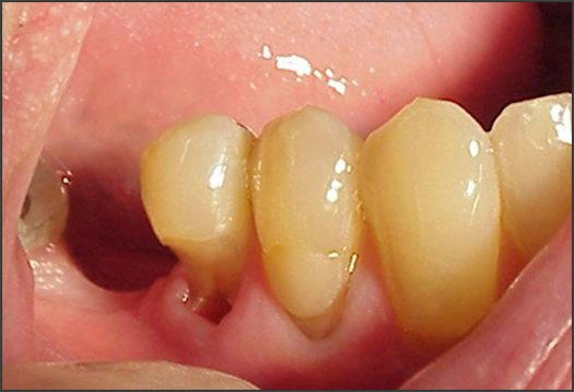 Photo showing tooth abrasion
