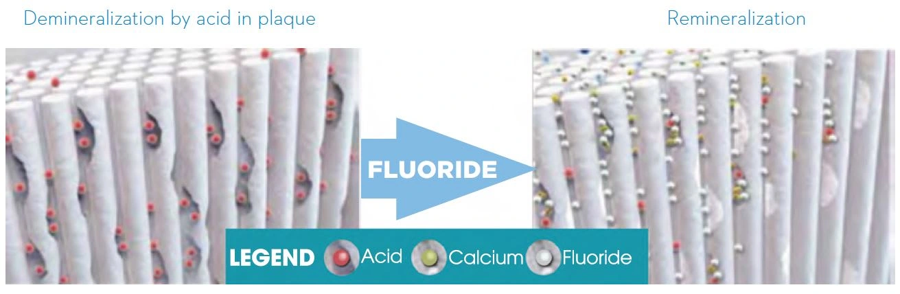 Demineralization by acid in plaque