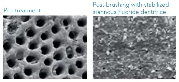 Pre-and post-brushing SEMs