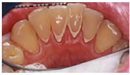 Supragingival calculus